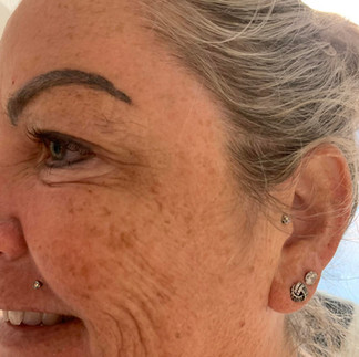 Serenbo Aesthetics Wrinkle Relaxing, Botox. After treatment showing side angle with reduced wrinkles in forehead and crows feet from wrinkle relaxing (botox) treatment. Wrinkle relaxing treatment South Wales.