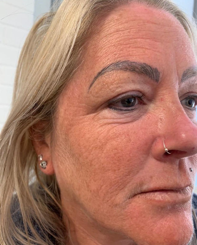 Serenbo Aesthetics Wrinkle Relaxing, Botox, Before and After February 2024. Image of client before wrinkle relaxing treatment at CV Makup Studio Cardiff Bay. Side angle showing forehead and crows feet wrinkles before botulinum toxin treatment. Wrinkle relaxing treatment South Wales.