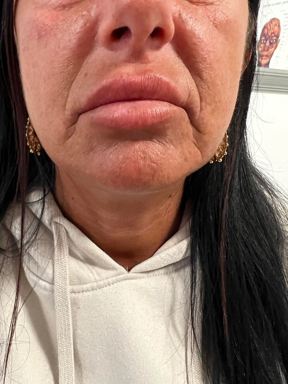 Dermal Filler Aesthetics Treatment Before and After March '24 