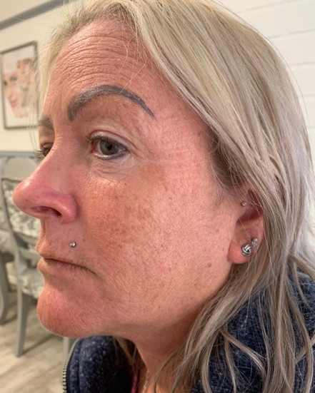 Serenbo Aesthetics Wrinkle Relaxing, Botox, Before and After February 2024. Image of client before wrinkle relaxing treatment at CV Makup Studio Cardiff Bay. Side angle showing forehead and crows feet wrinkles before botulinum toxin treatment.
