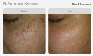 IPL Pigmentation Correction Before & After 02.png
