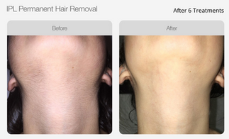 IPL Hair Removal Before & After 02.png
