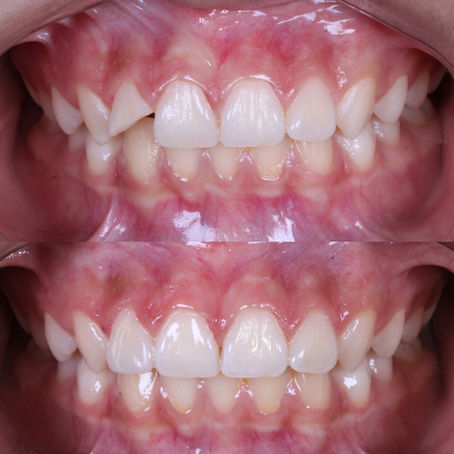 Meu dente quebrou, o que fazer?