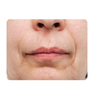 Fine lines and wrinkles treatment
