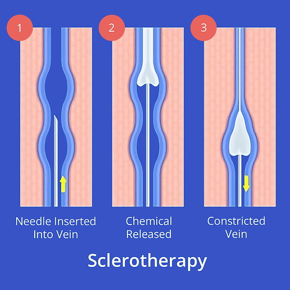 a diagram showing sclerotherapy, needle inserted into vein, chemical released, vein constricted