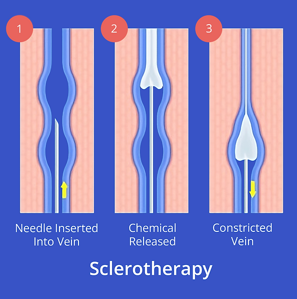 a diagram showing sclerotherapy, needle inserted into vein, chemical released, vein constricted