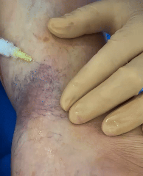 a gif showing sclerotherapy in real time clearing up spider veins