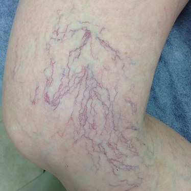 Leg affected with spider veins