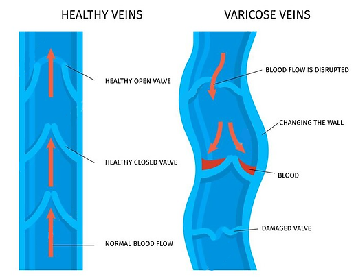 Diagram showing healthy veins vs varicose veins, with valves