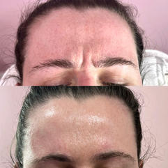Botox Anti-Wrinkle