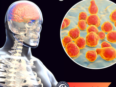 09/03/24 Public Health Education Topic: Meningitis