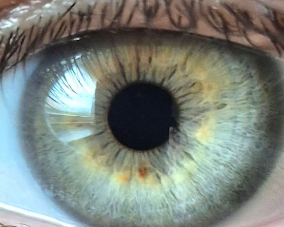 Striking grey and gold eye showcasing the unusual colour variation known as central heterochromia.