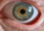 Blue-grey iris with central heterochromia featuring an amber-gold centre and intricate iris patterns.