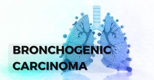 Bronchogenic Carcinoma: An Overview for MRCP (UK) Part 1 Candidates