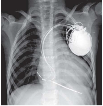 Morte Súbita Cardíaca e Cardiodesfibrilador Implantável (CDI).