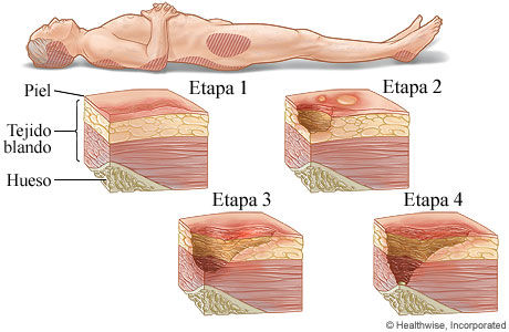 Clasificación de las Escaras