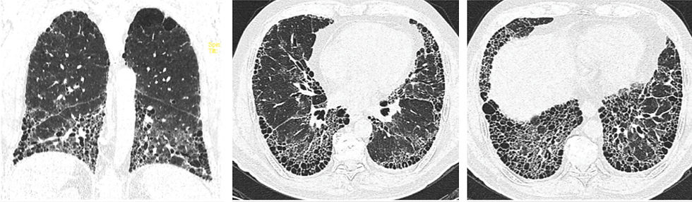 Diagnostico de EPID
