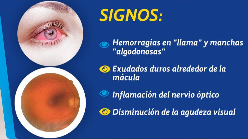 síntomas de Retinopatía por Hipertensión