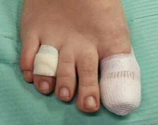 erbandtechnik: TubeGaze und Zehenverband