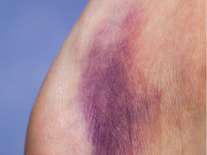 What to Know About Foot Sprains and Fractures