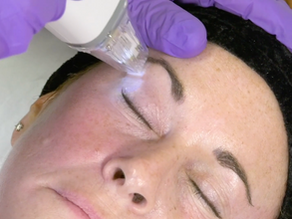 Potenza RF Microneedling