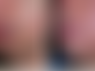 Potenza RF Microneedling