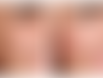 Xerf RF Skin Tightening