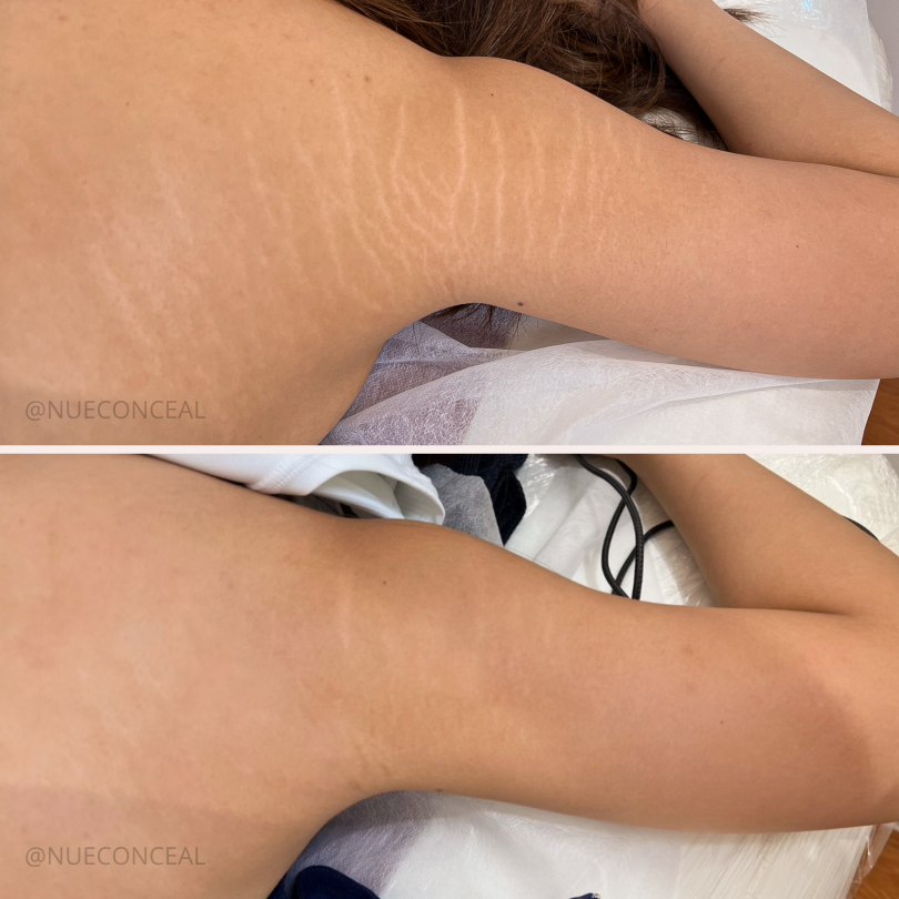 Before and after showing the effects of inkless stretch mark revision treatment on the arm, highlighting smoother skin texture and reduced visibility of stretch marks.