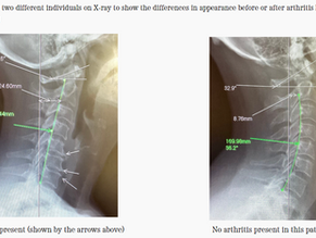 Arthritis: Is It Truly Inevitable?