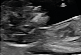 First Trimester Screening Hands-on Ultrasound Workshop by EmpowerUS, Delhi.png