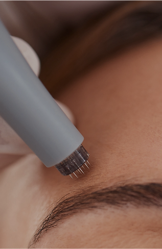 radio frequency microneedling procedure