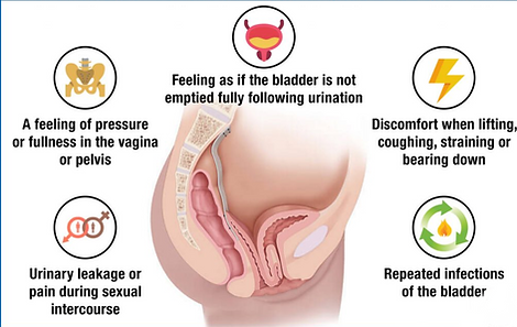 Cystocele_edited.png