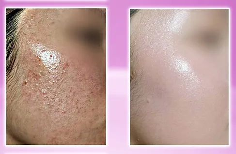 ルビーセル ヒト幹細胞培養液 効果ビフォーアフター