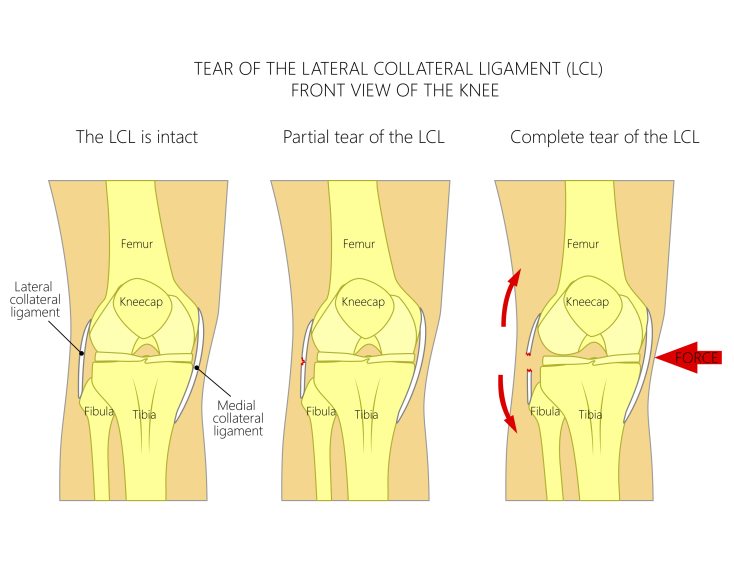 Lateral Collateral Ligament Injuries