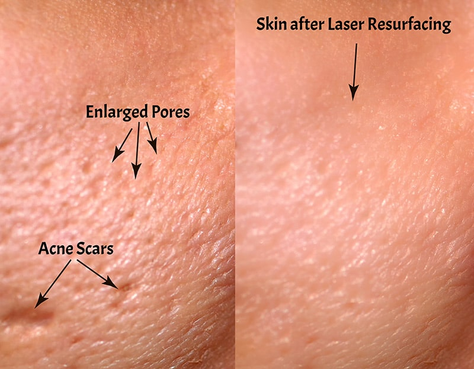 erbium vs CO2 laser skin resurfacing