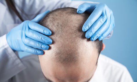 Hair Rejuvenation with PRP and Exosomes: A Natural Path to Thicker, Healthier Hair