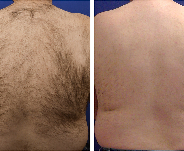 Before and after Laser Hair Removal treatment, showing a hair-free skin.