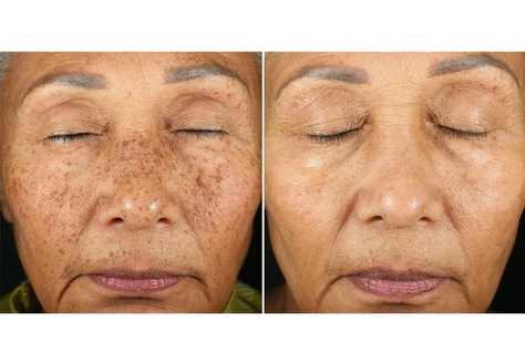 Pico Laser for Hyperpigmentation and Skin Rejuvenation: A Superior Solution at Blue Iris Medical Aesthetics