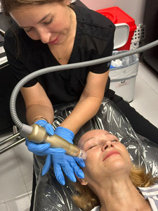 RF Microneedling for Face and Body