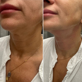 neck skin laxity before and after pdo threads