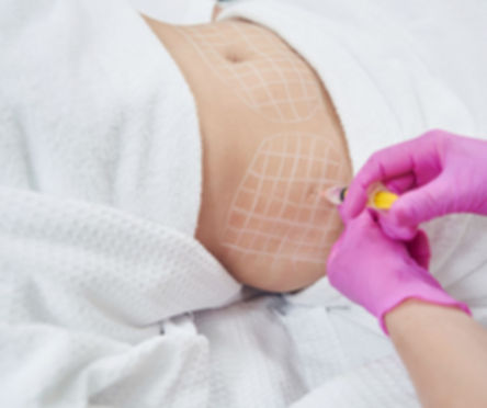 A woman's belly while undergoing lipolytics injection treatment
