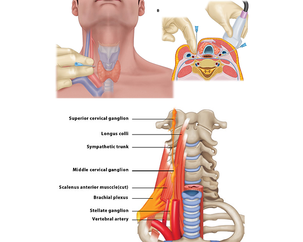 img-Stellate-Ganglion-Block .png