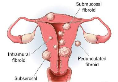 Understanding Uterine Fibroids: Causes, Symptoms, and Treatment Options