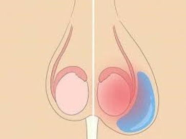 hydrocele diagram