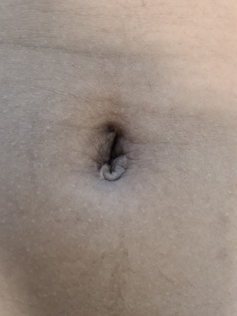 SILS scar example