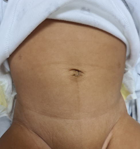 hernia laparoscopic scars