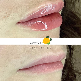 Before and after photos of lips at Citrus Aesthetics following a fillers treatment. The transformation showcases smoothed wrinkles and enhanced volume. Fillers used for such impeccable results include choices like Juvederm, Restylane, RHA, and Radiesse.