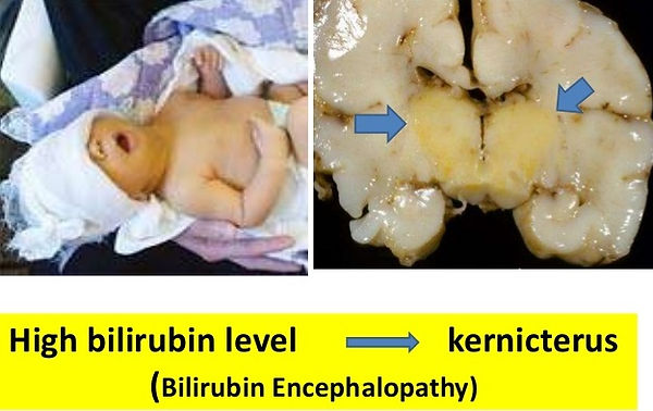 Neonatal Jaundice Kernicterus crop.jpg