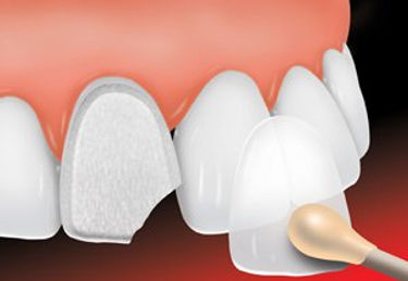 ada_dental_veneer_1_new.jpg