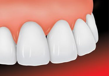 ada_dental_veneer_2_new.jpg